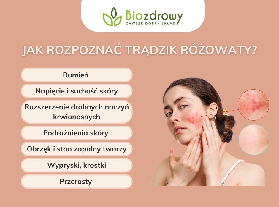 Jak rozpoznać trądzik różowaty - infografika