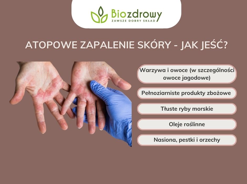 Atopowe zapalenie skóry - jak jeść - infografika