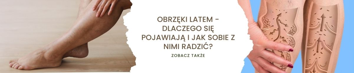 Obrzęki latem - dlaczego się pojawiają i jak sobie z nimi radzić - obrazek zobacz także