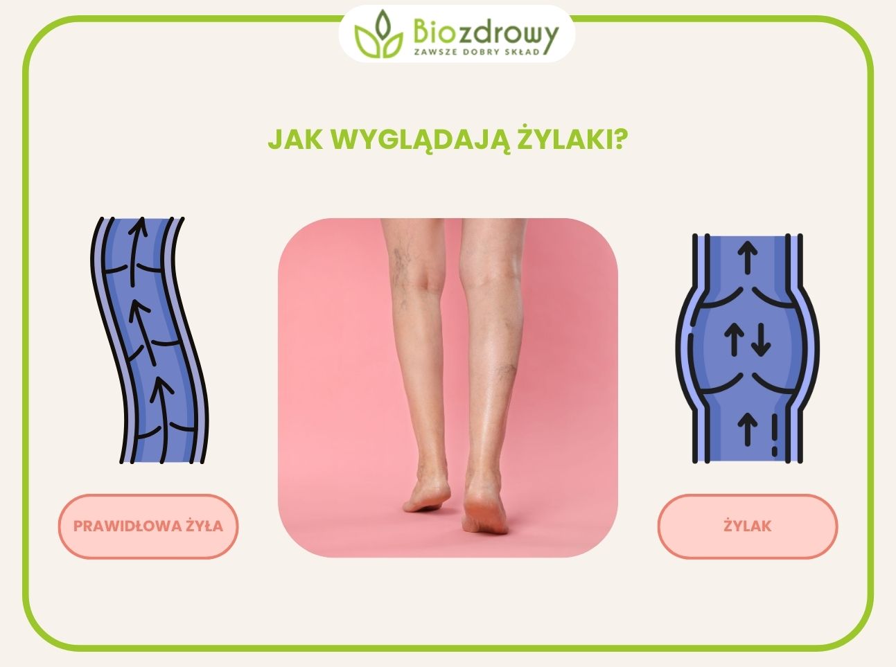 infografika jak wyglądają żylaki